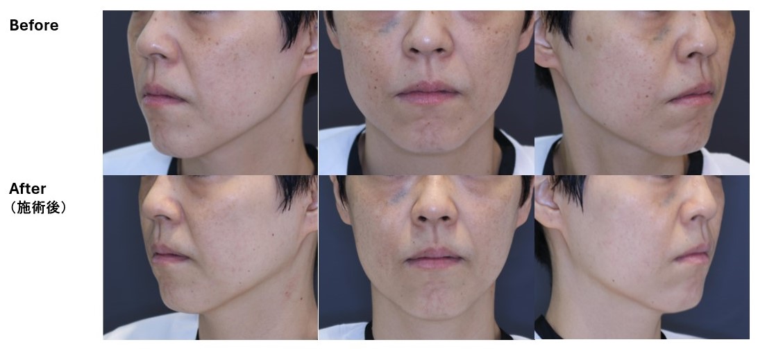 【くすみ・肝斑】