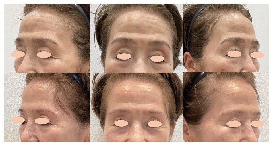 眉毛下皮膚切除術