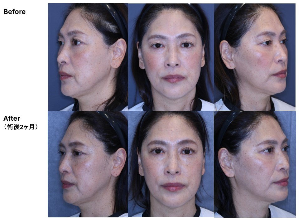 重瞼線余剰皮膚切除術