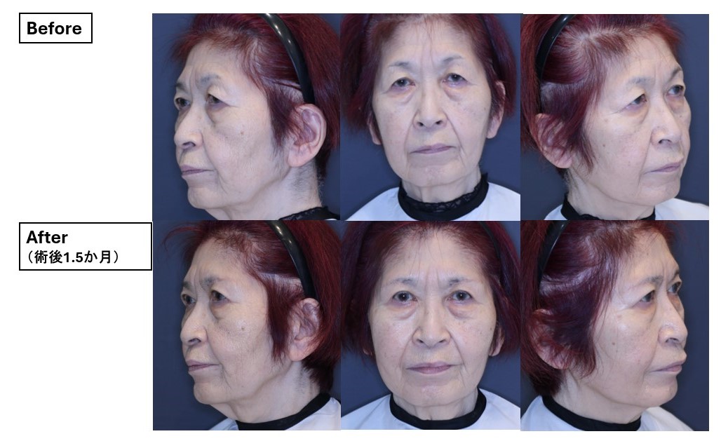 眉毛下皮膚切除術