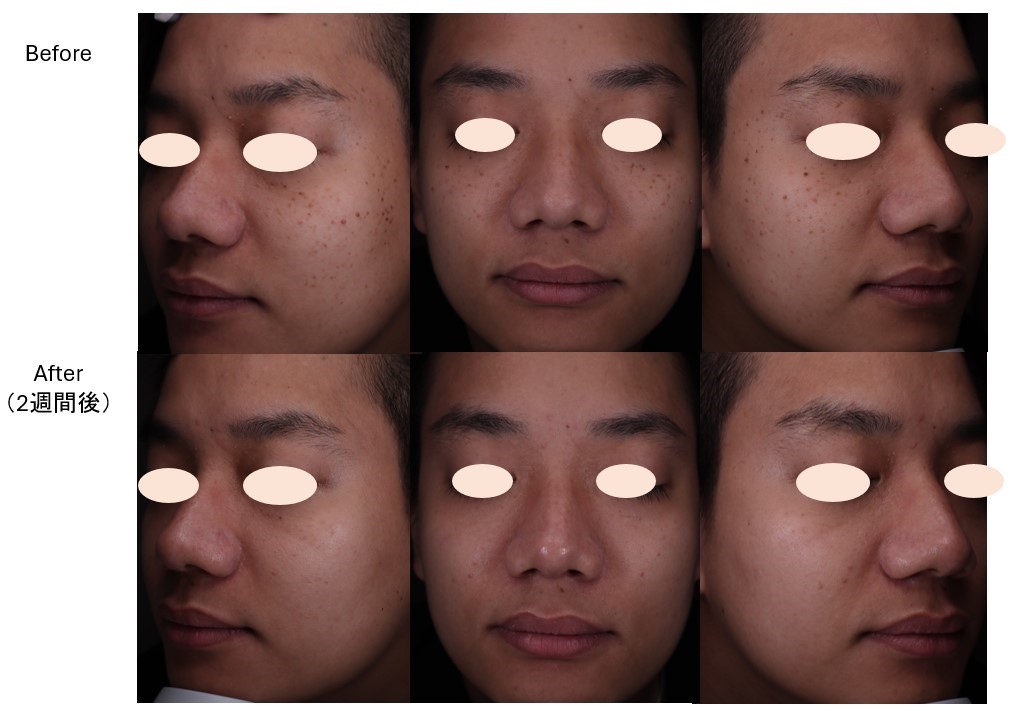 顔全体いぼ取り放題CO2レーザー