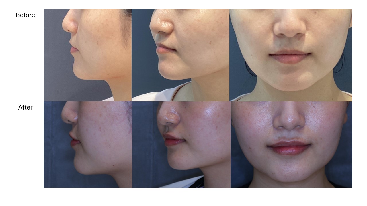 【リップヒアル】