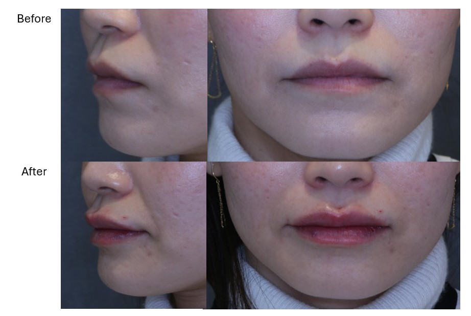 【リップヒアル】