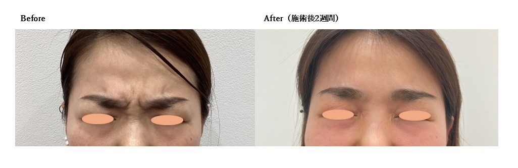 【ボトックス：眉間】
